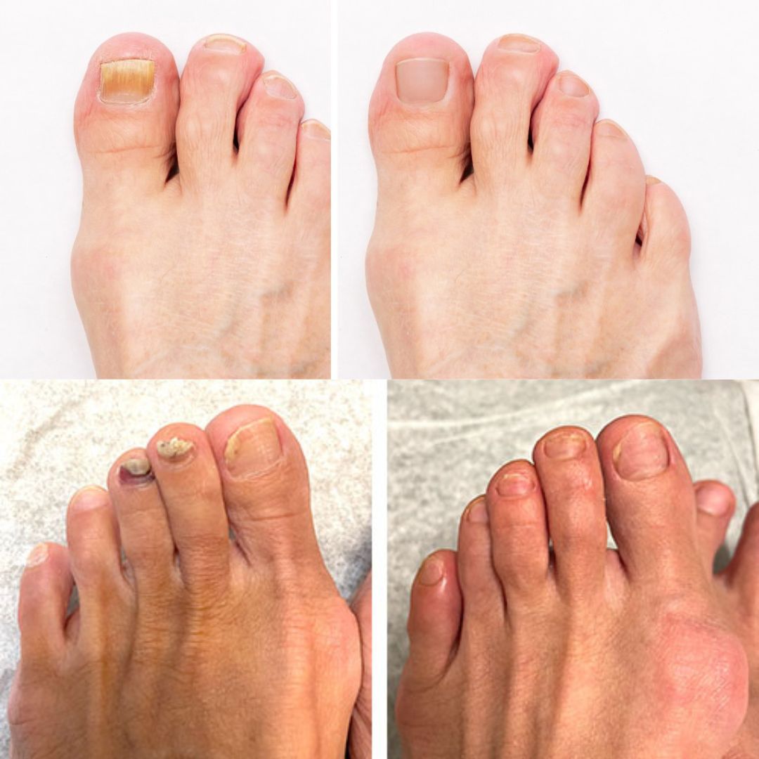 PureNail - Patented nail fungus therapy – for healthy nails within 4 weeks