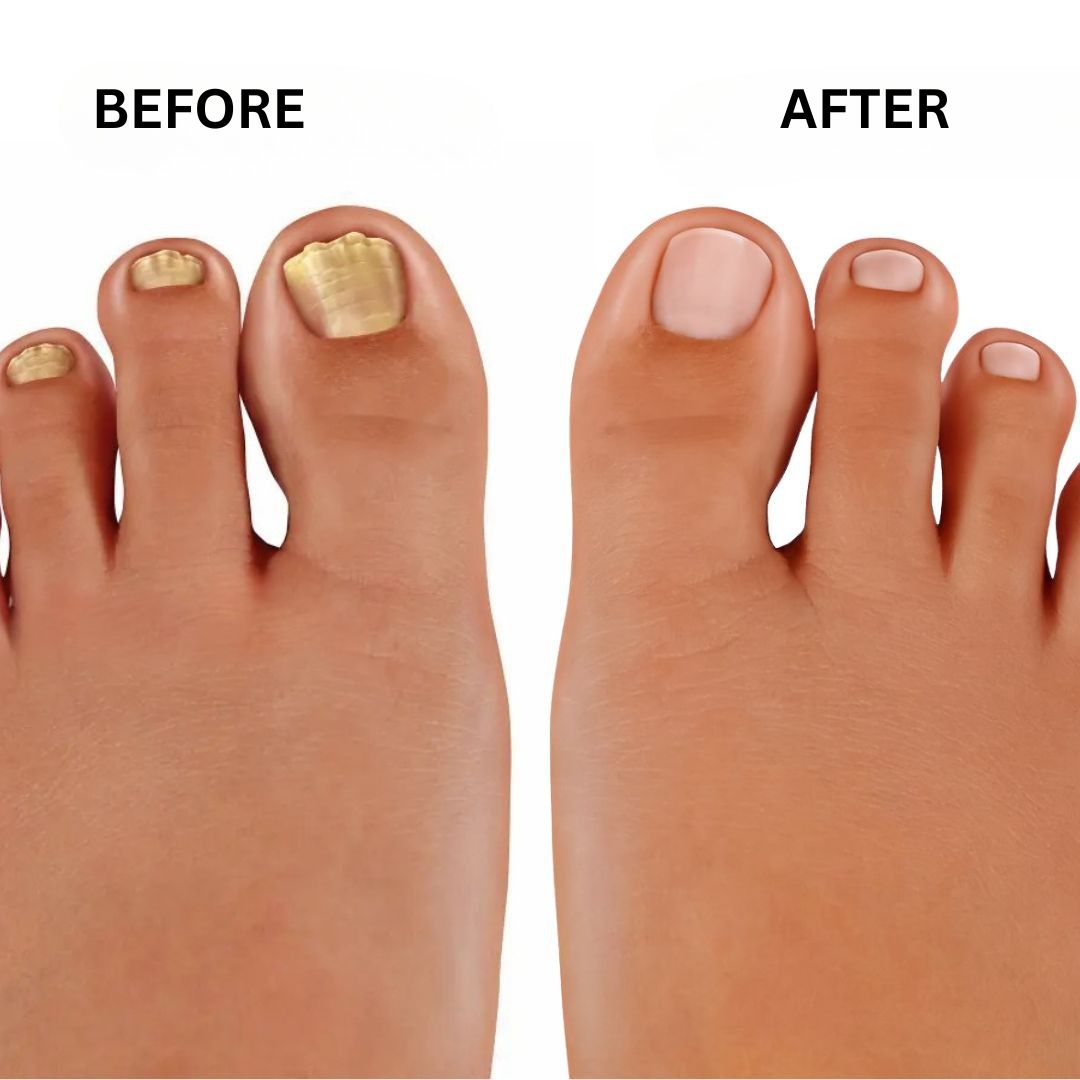 PureNail - Patented nail fungus therapy – for healthy nails within 4 weeks